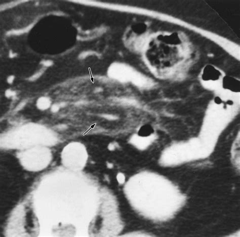 Ct Evaluation Of Mesenteric Panniculitis Prevalence And Associated