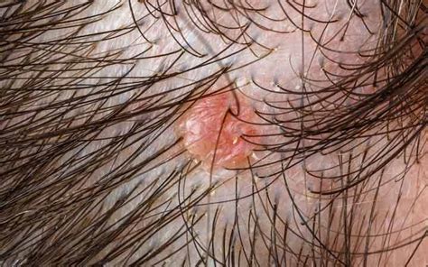 8 Types Of Scalp Folliculitis And Ways To Get Rid Of Them Skinkraft
