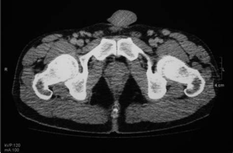 Ct Scan Of Pelvis Indicating Multiple Enlarged Lymph No Open I