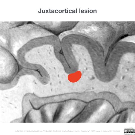 Subcortical U Fibers And Juxtacortical Lesions Illustration Image