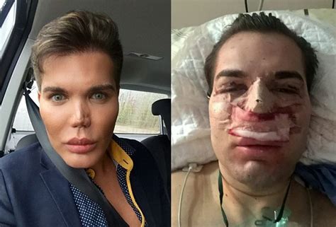 Check spelling or type a new query. Human Ken doll Rodrigo Alves getting new nose on NHS after ...