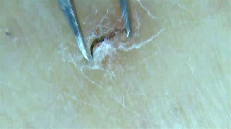 2 Slimy Ingrown Hairs In One Dont Miss This Youtube