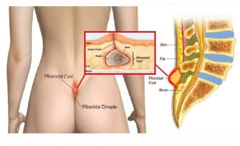 Pilonidal Cyst Symptoms Treatments Surgery Human N Health