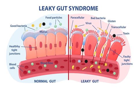 How Leaky Gut Affects Autoimmune Diseases The James Clinic Functional