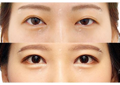 korean eyelid surgery before and after