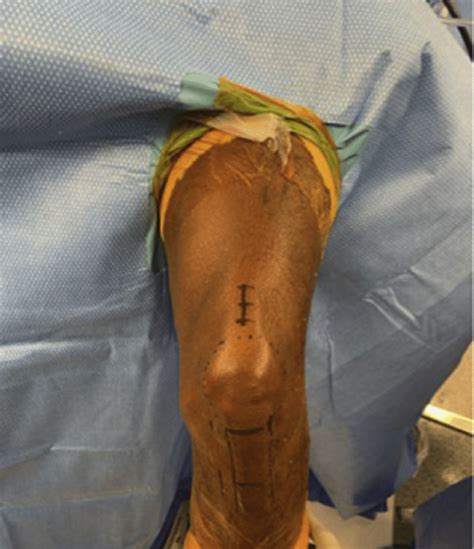 Planned Incisions For Quadriceps Tendon Harvest And Arthroscopic