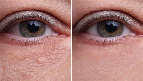 How To Treat Under Eye Bags And Wrinkles Discoverhealth
