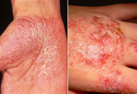 Plaque Psoriasis Vs Eczema
