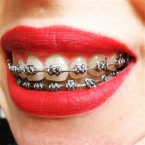 Braces Girlswithbraces Metalbraces Dental Braces Braces Treatment