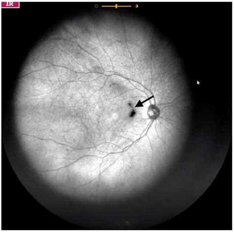 Jcm Free Full Text Visualization And Grading Of Vitreous Floaters