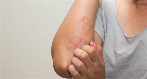 Lupus Skin Rash Symptoms And Treatment Tips For Health