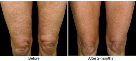 Tighten Loose Skin On The Legs And Knees With Thermage Skin Tightening