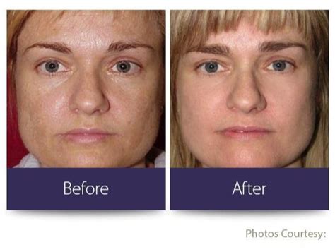 Clearlift Lunchtime Facelift — Symbios Health Primary Care