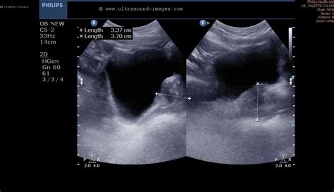 Ultrasound Prostate Radiotherapy