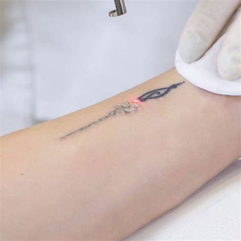 Tattoo Removal Skin Secrets Beauty Clinic Pudsey Leeds