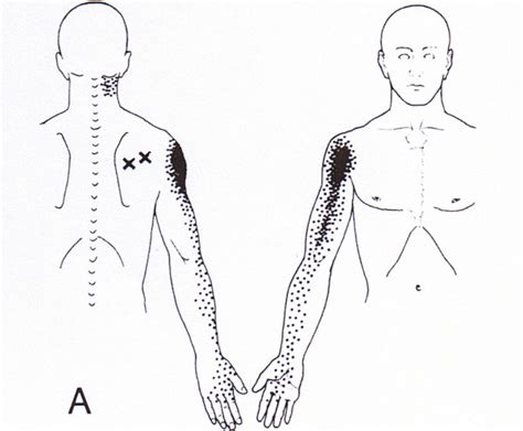 Infraspinatus Trigger Point Referred Pain Pattern Permission