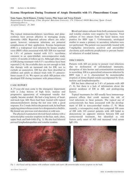Pdf Eczema Herpeticum During Treatment Of Atopic Dermatitis With 1