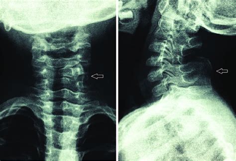 Plain Radiographs Of The Cervical Spine Demonstrated An Anomalous Bone