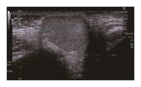 Ultrasonography Of The Left Parotid Gland Showing A Well Defined