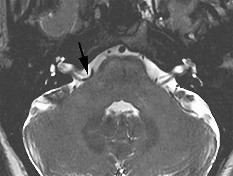 Hemifacial Spasm Facial Twitching Expert Surgeon Aaron Cohen Gadol Md