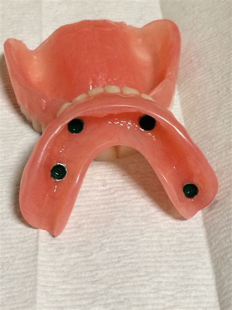 Implant Denture Dunnville Denture Clinic
