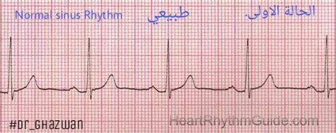 شرح تخطيط القلب الكهربائي Ecg وتحديد الحالة من رسم القلب