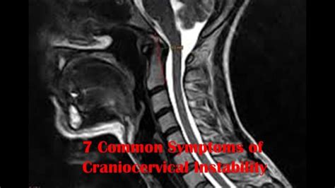 Craniocervical Instability Symptoms The 8 You Need To Know 2022