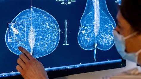 Mammogram Clinics Must Notify Women If They Have Dense Breast Tissue Fda