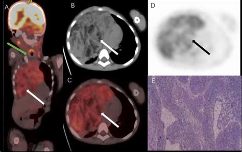 Frontiers Case Report Imaging Findings Of True Thymic Hyperplasia At