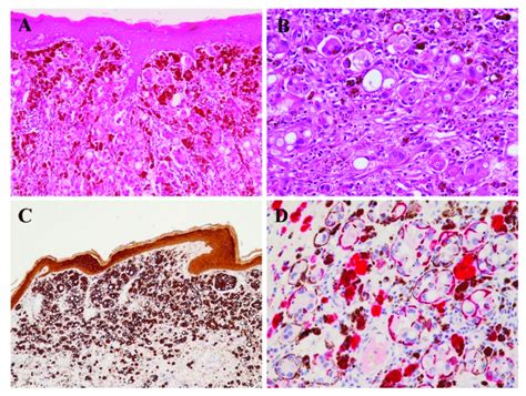 Histological And Immunohistochemical Features Of Case 2 A Low Power