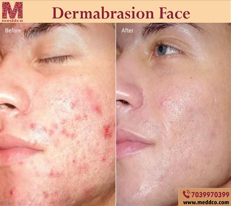 How Often Should You Dermabrasion Your Face