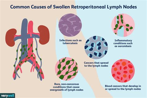 Overview Of Enlarged Retroperitoneal Lymph Nodes