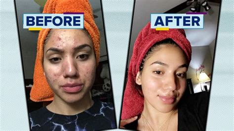 Never mix strong vitamin a based medicines with other acne creams that could trigger dryness. How a teen cleared her acne using cheap products Video ...