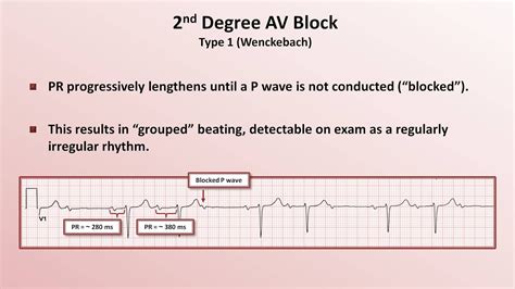 May be found during a routine electrocardiogram (ecg) although heart rate and rhythm are usually normal. Intro to EKG Interpretation - AV Block - YouTube