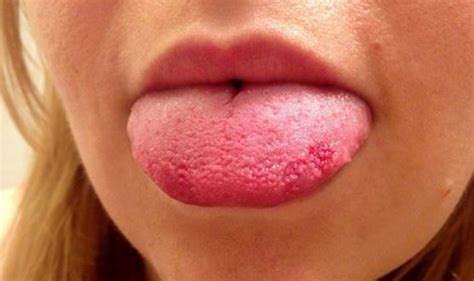 Swollen Taste Buds Inflamed Causes On Sides Tip Under