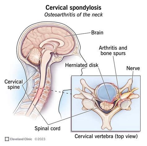Cervical Spondylosis What It Is Symptoms Treatment
