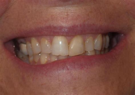 Dentist 02332 Restoring Worn Down Teeth To A Beautiful Smile