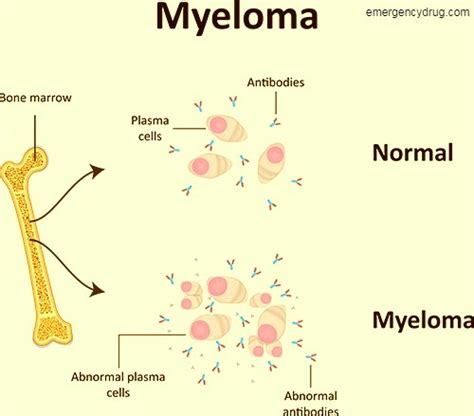 Multiple Myeloma Symptoms Diagnosis And Treatment Emergency Drug