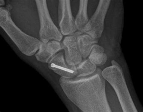 Trauma Wrist Carpal Fractures And Dislocations Eg Scaphoid Dr Neil Kruger