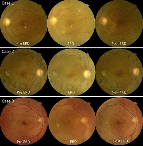 Color Fundus Photographs Showing The Time Course Of Changes In 3 Cases
