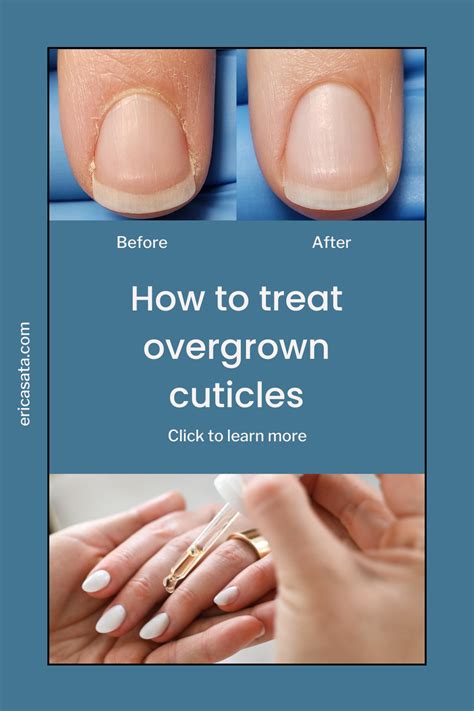 How To Treat Overgrown Cuticle Ericas Dry Manicure Brittle Nails