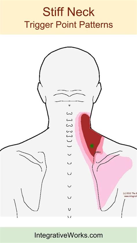 Understanding Trigger Points For Stiffness Up The Side Of The Neck