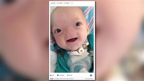 Eli Thompson Miracle Baby Born Without Nose Dies At 2 Years Old