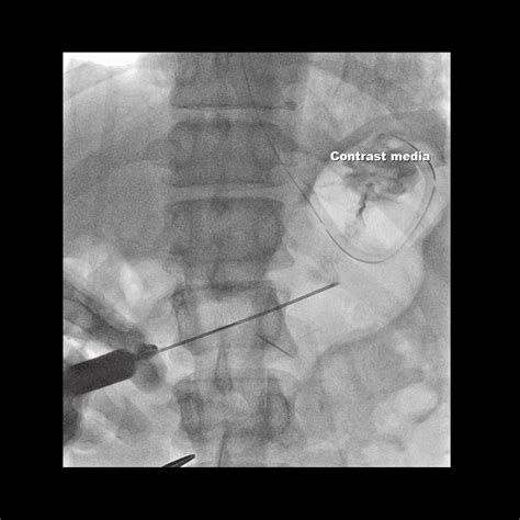 Case 14 Percutaneous Radiologic Gastrostomy Navigating Angles With