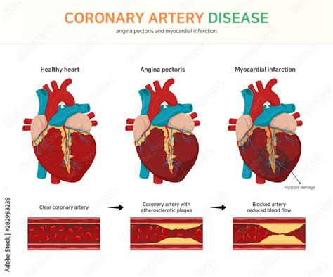 Coronary Artery Disease Angina Pectoris And Myocardial Infarction