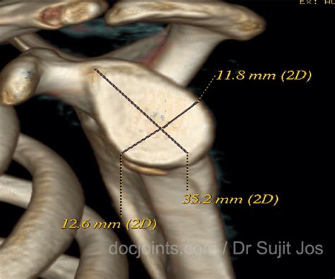 Shoulder Dislocation With Bone Loss Docjointsdr Sujit Josjoint