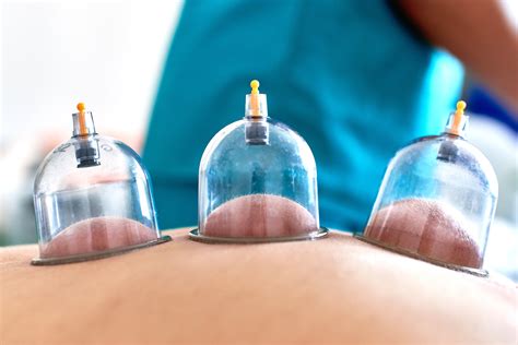 Cupping Therapy Hijama