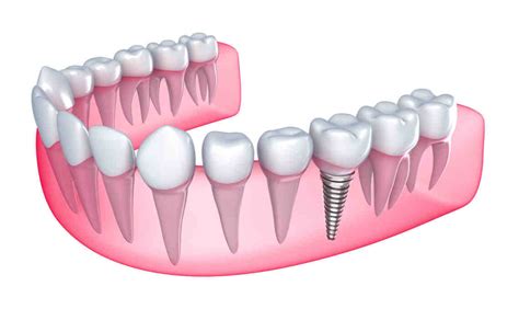 Can You Get Dental Implants If You Have Had Dentures For Years Dental