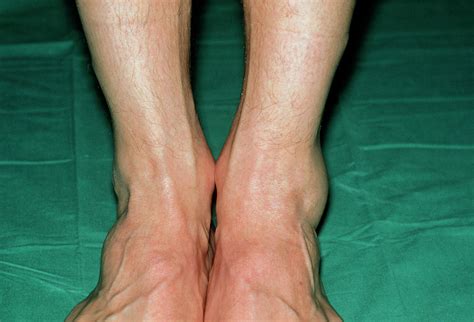 View Of Swollen Left Ankle Due To Sprain Photograph By Dr P Marazzi