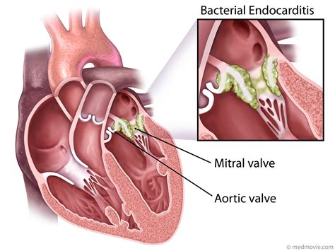 Bacterial Endocarditis Medmovie Heart Valves Cardiac Nursing